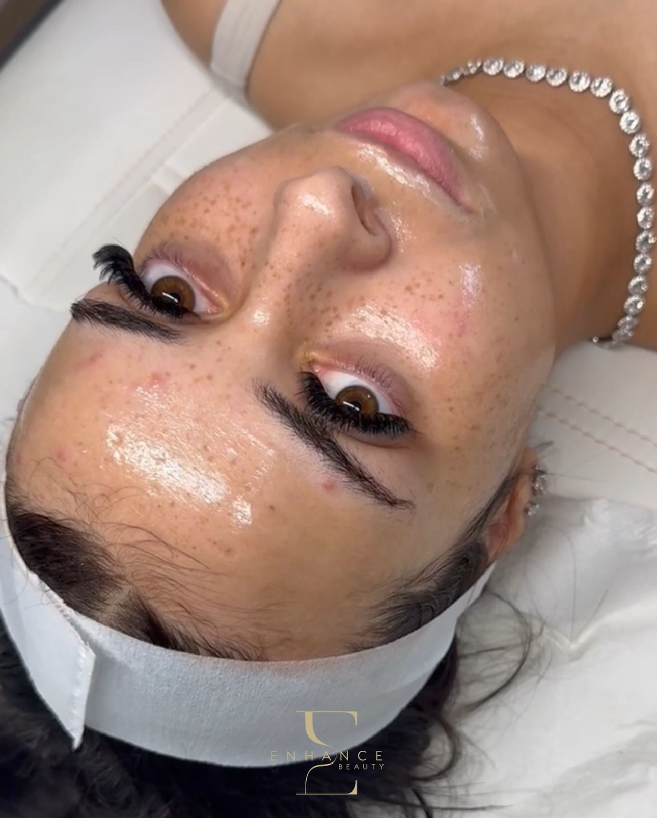 Skin treatment result at Enhance Beauty Aylesbury