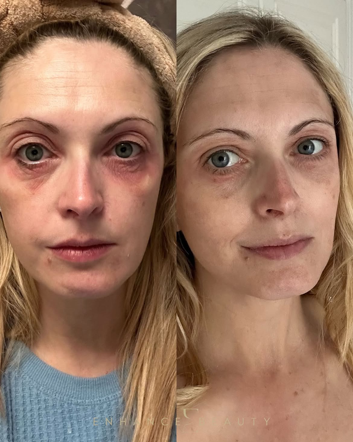 Skin transformation at Enhance Beauty Aylesbury