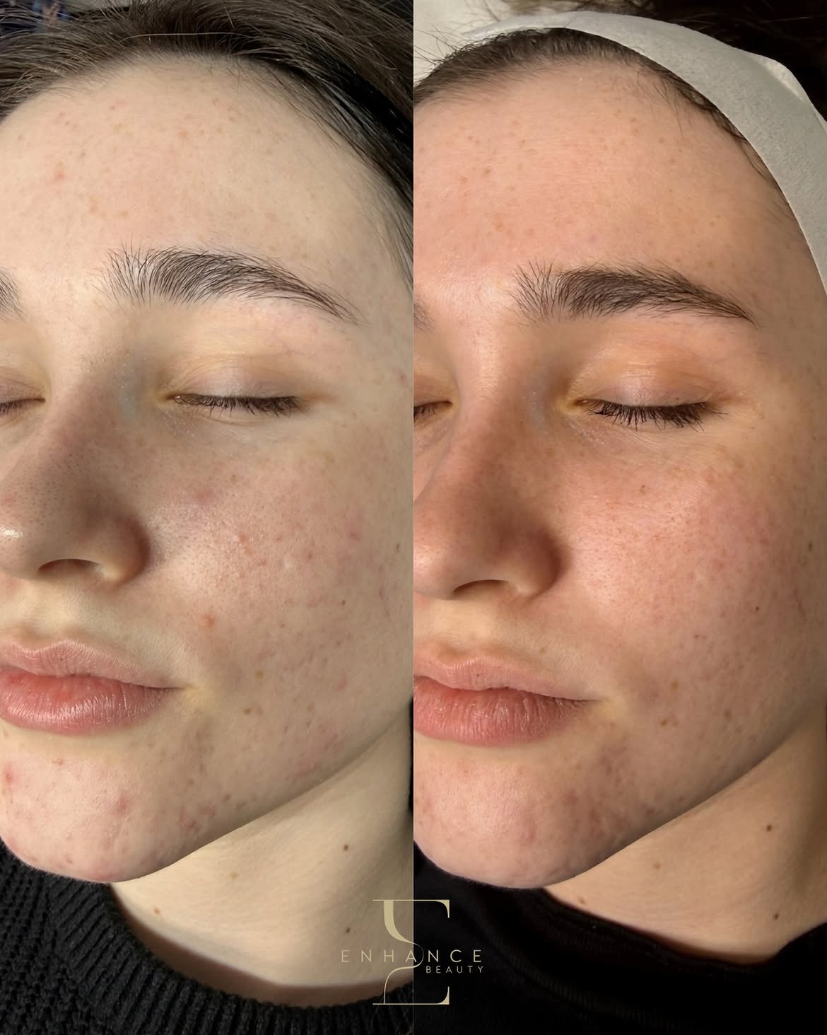 BYONIK laser facial at Enhance Beauty Aylesbury