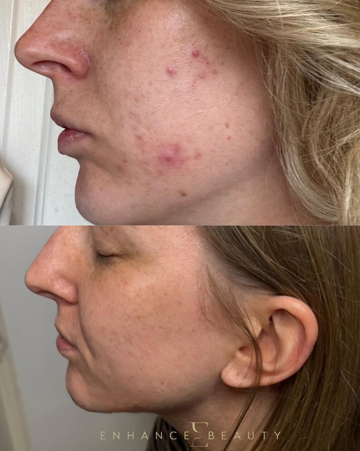 Client during an Acne and Skin Health Consultation at Enhance Beauty Aylesbury