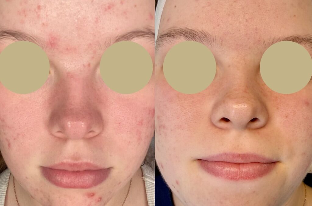 Acne & Skin Health Consultation