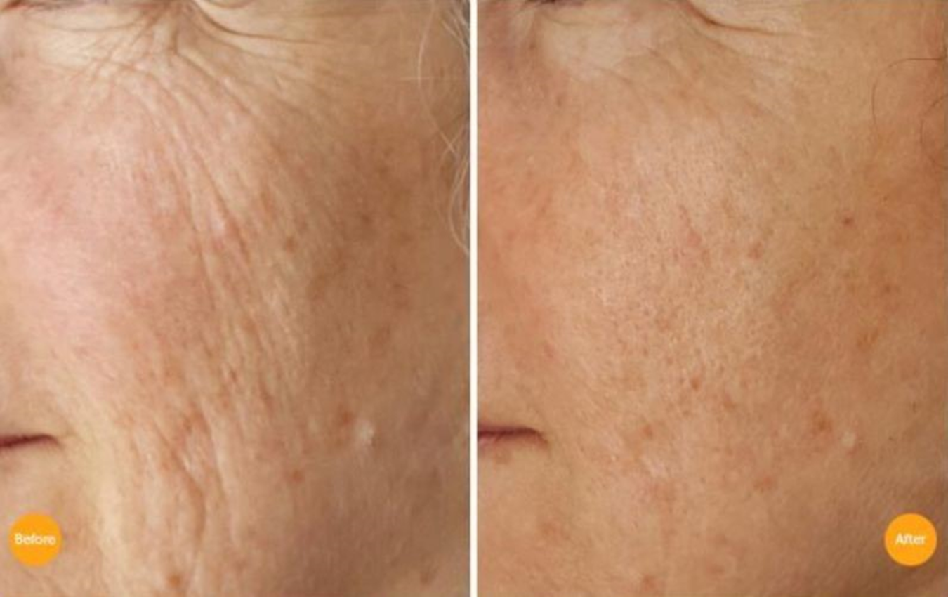 Mezotix before and after results