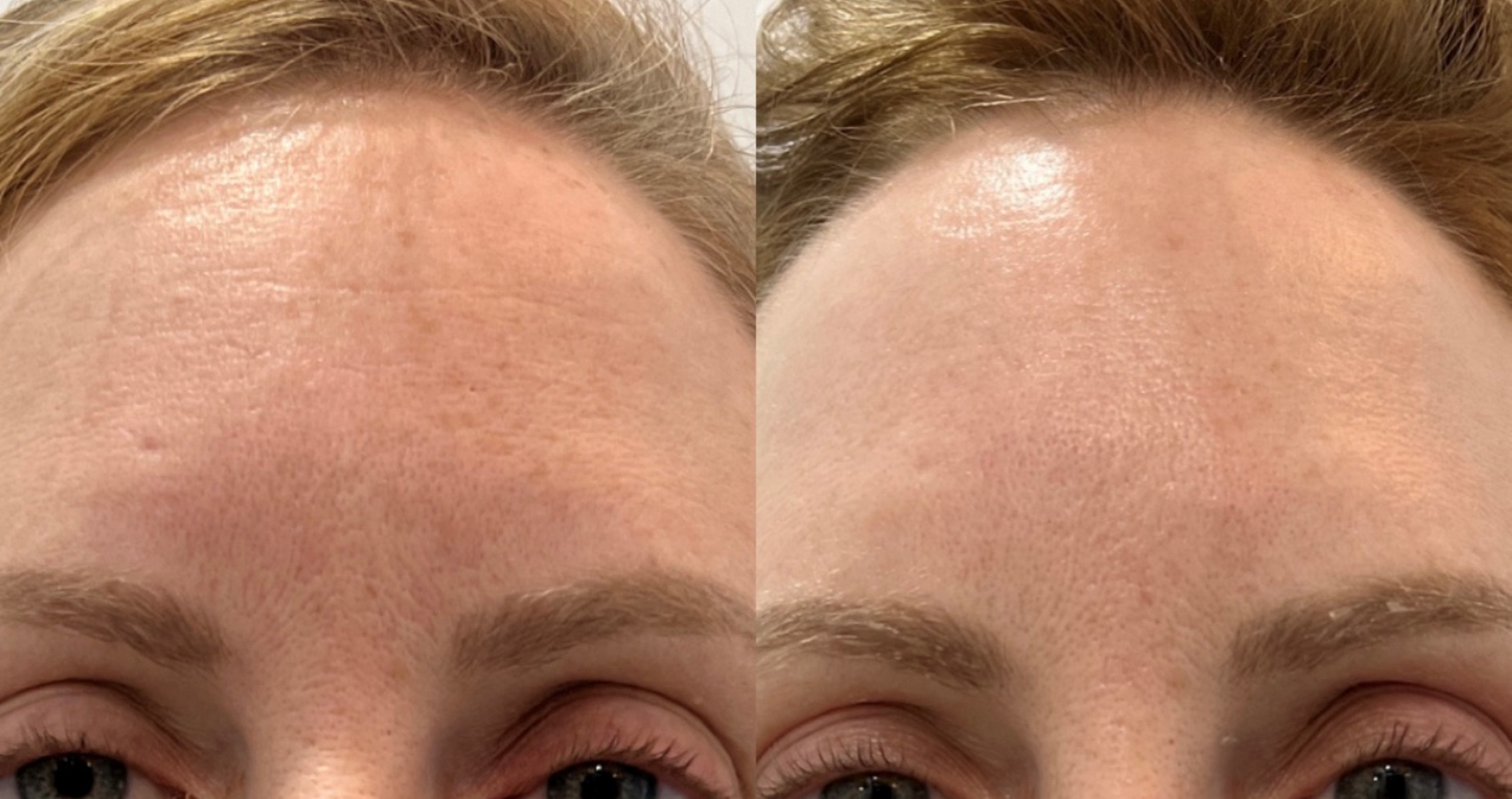 Mezotix before and after results