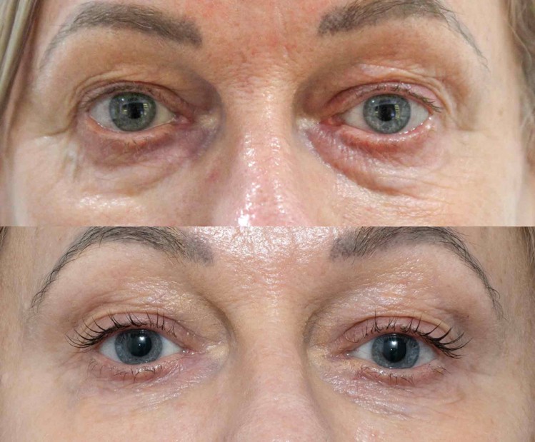 Mezotix before and after results