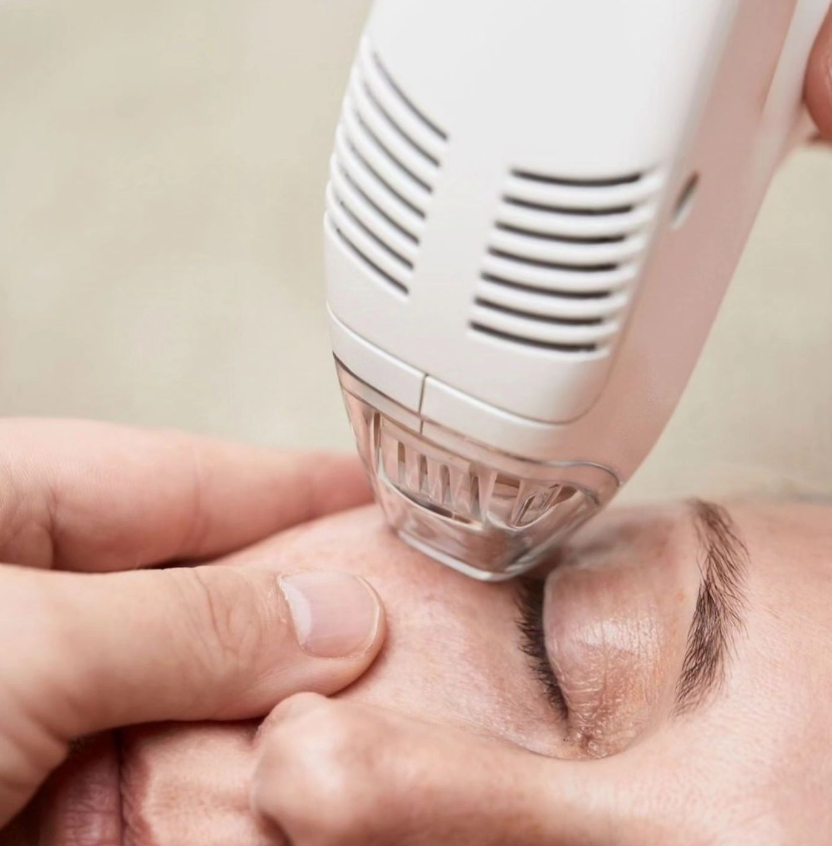 Mezotix eye area treatment